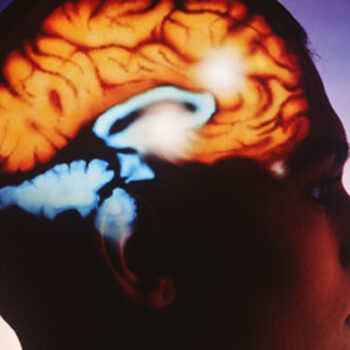 ایمپلنت مغزی به کمک بیمار ALS آمد